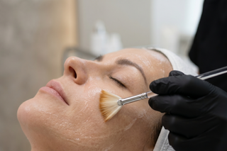 Chemical skin peel treatment at The Kelly Clinic Dublin